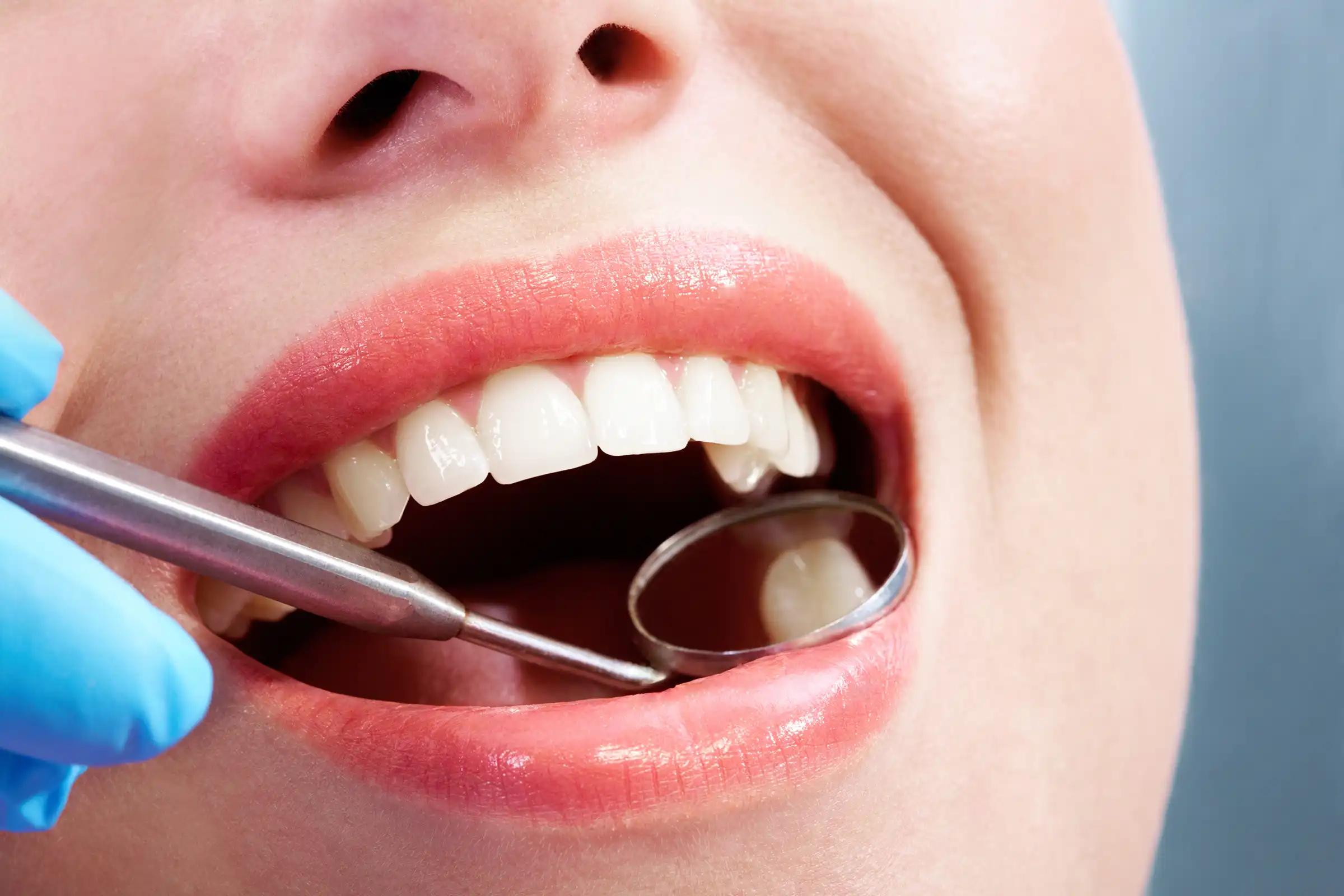 Coloured Fillings Coloured Fillings