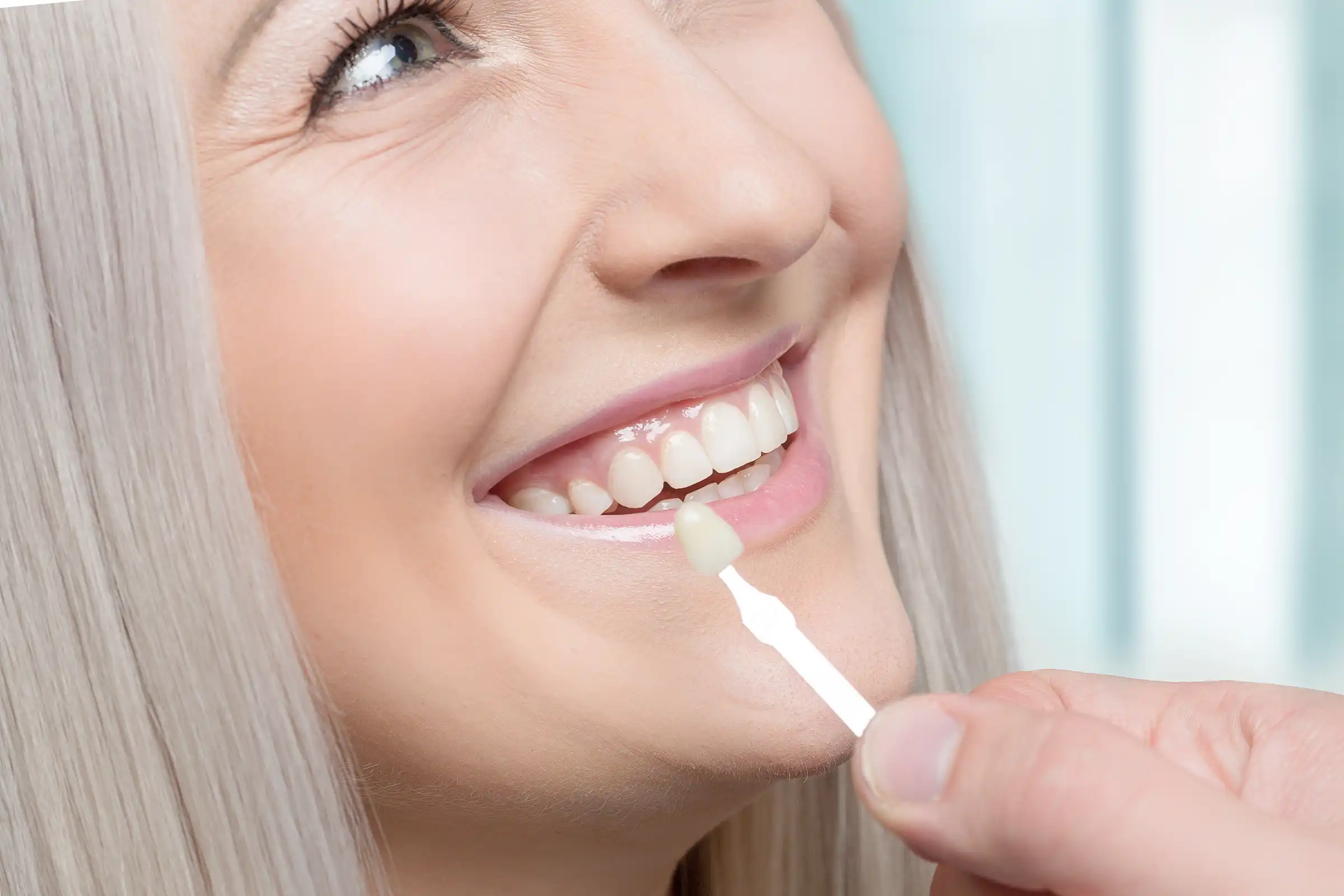 Veneers Veneers