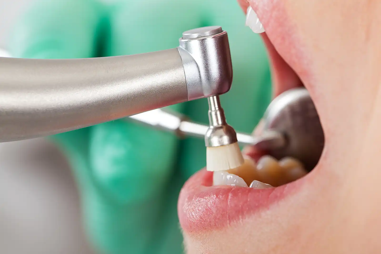 Hygienist Regular Visits
