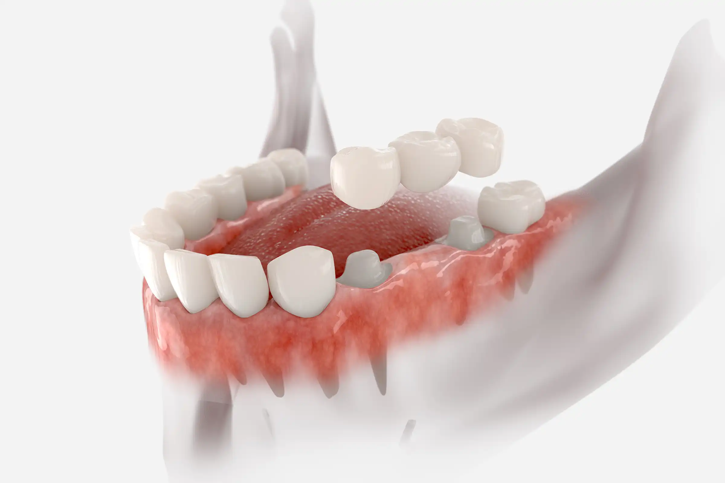 Dental Bridges Dental Bridges