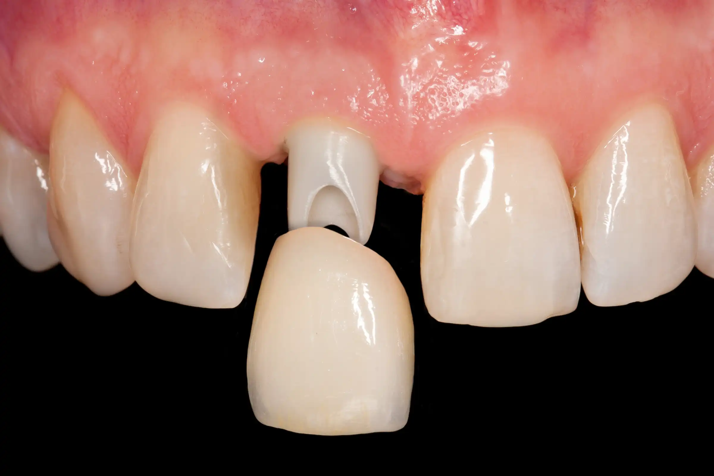Dental Crowns Dental Crowns